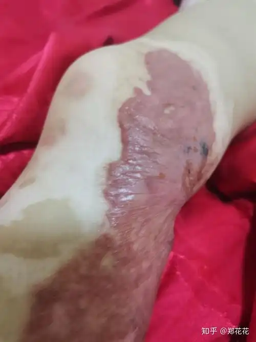 孩子烫伤四个月疤痕增生期