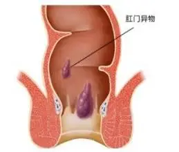 肛门有个软软的肉疙瘩怎么办?