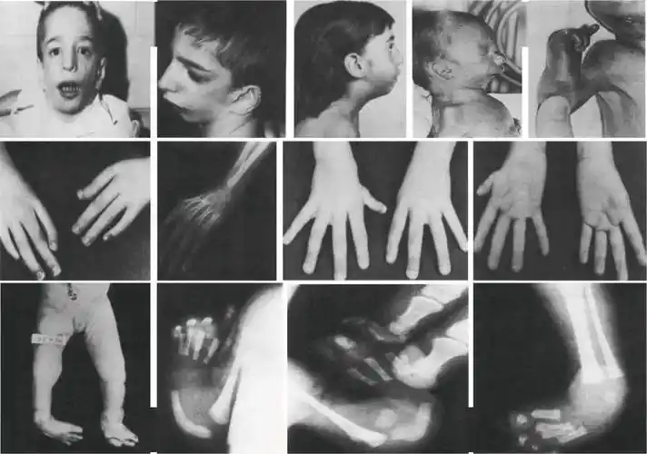 重磅国际首例性腺基因嵌合行pgt助孕婴儿在我院顺利诞生