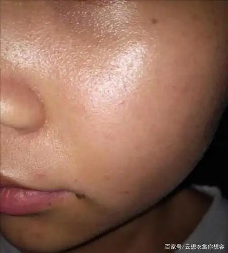 油性皮肤出油量太大,这油一多,就容易着附在皮肤的表面.