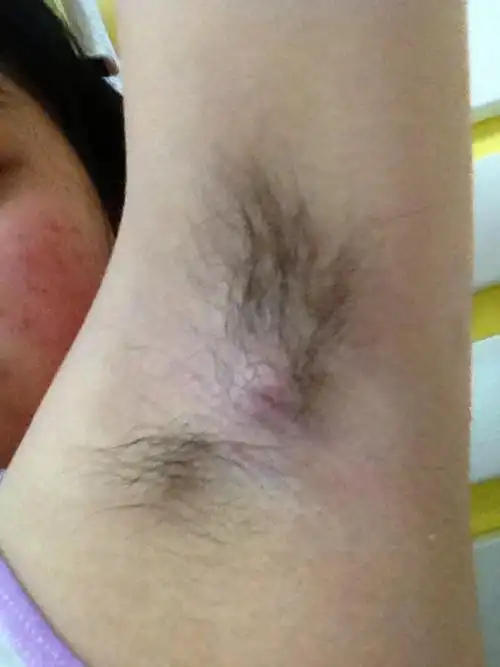 女性腋下淋巴结肿大_有来医生