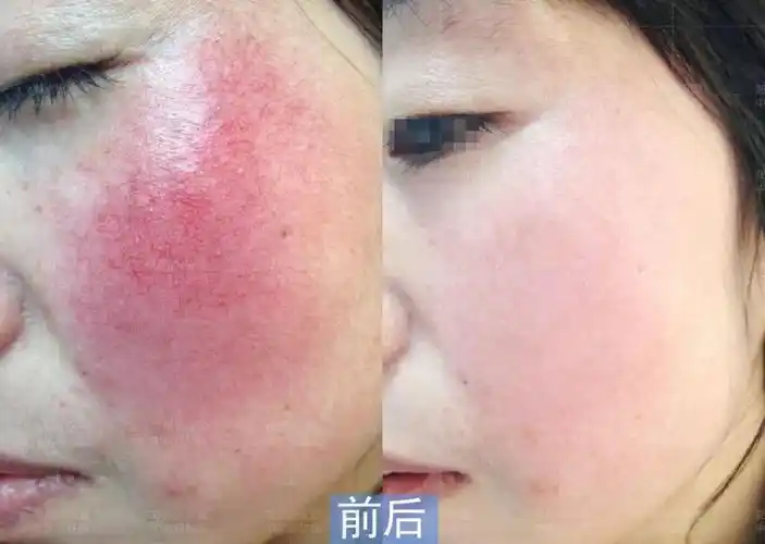 那么要怎么摆脱红血丝?