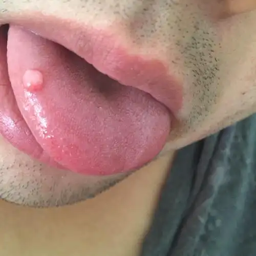 舌头上起个白泡快一年了还没下去怎么办