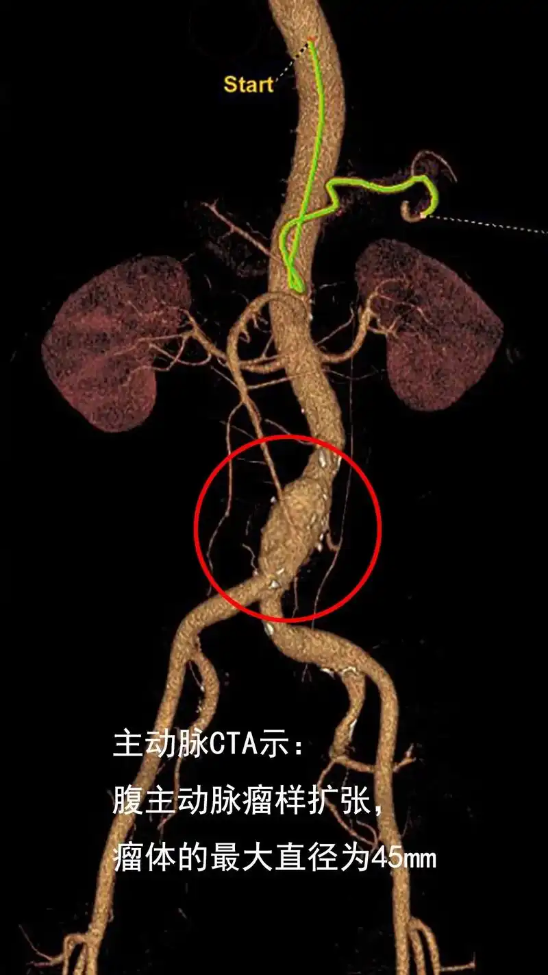 腹主动脉覆膜支架腔内隔绝术