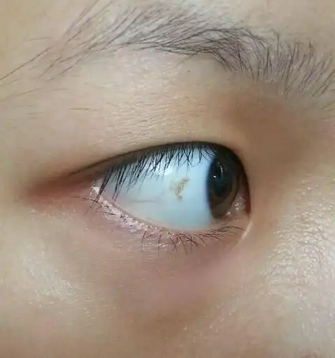 右眼眼白部分长了一个黄斑,如图,没有任何感觉,本身是近视,可能有一