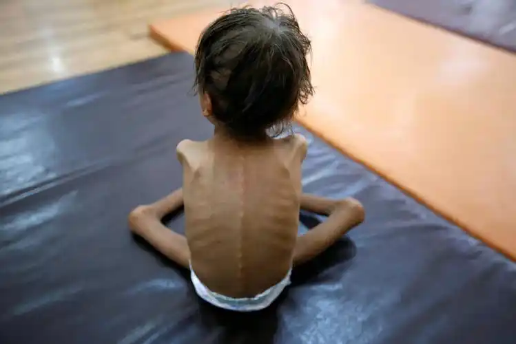 也门儿童患营养不良瘦成"皮包骨" 触目惊心