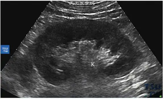 正常肾超声图像: 肾脏自外向内依次为肾被膜轮廓线,中等回声略偏低的