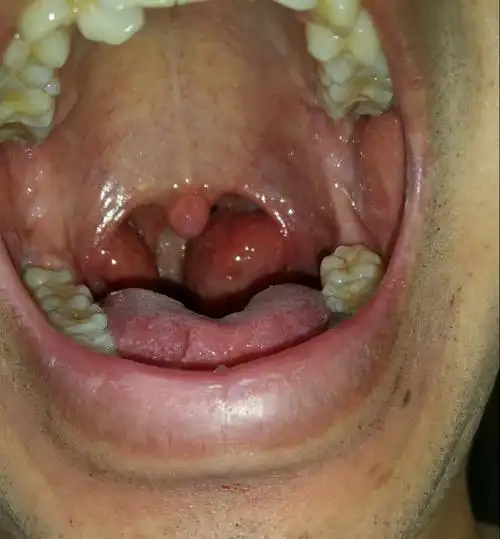 扁桃体三度肿大(腰痛,低热,肾虚的症状),有二十年乙肝病史,_王先忠