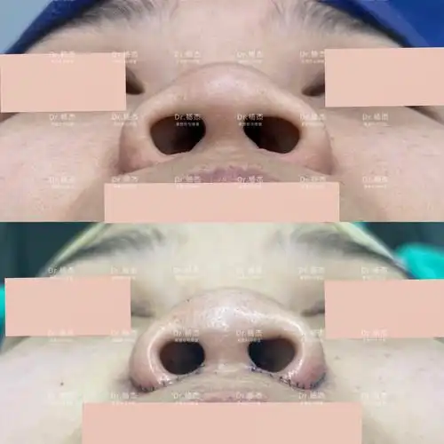 【内外联合鼻翼缩小 鼻槛上提】-杨杰-爱问医生