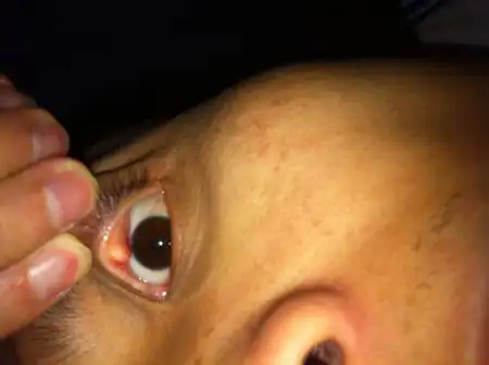 麦粒肿/霰粒肿后,眼皮留下一个肉色疙瘩 不痛不痒不长大