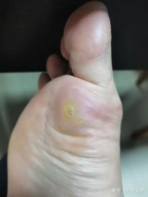 战胜孕期最大的烦扰——跖疣 - 知乎