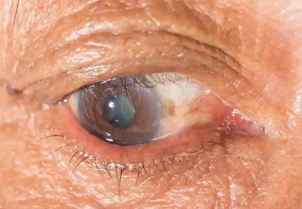 沙眼的影响有哪些,如何治疗?