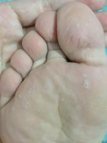 脚底长了很多这样的小洞,是怎么回事?求解答!