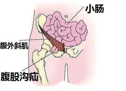 成人疝气不觉得痛需要做手术吗