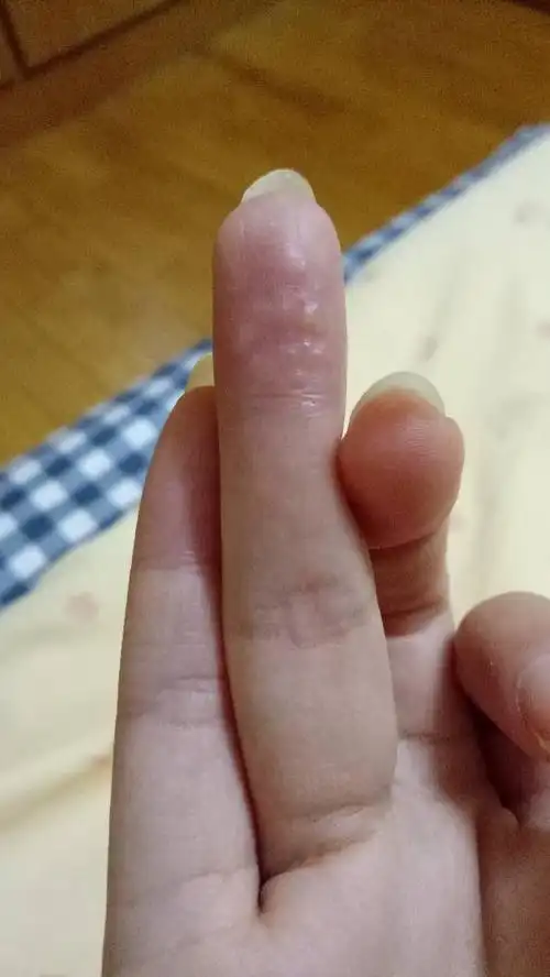 手指长这种小颗粒 很痒 怎么回事 病了吗 要怎么做才会好?