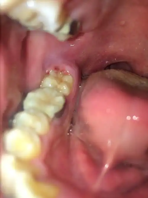 痛的睡不着 前几天带了牙套 今天早上一醒发现右下边牙齿最后一颗后面