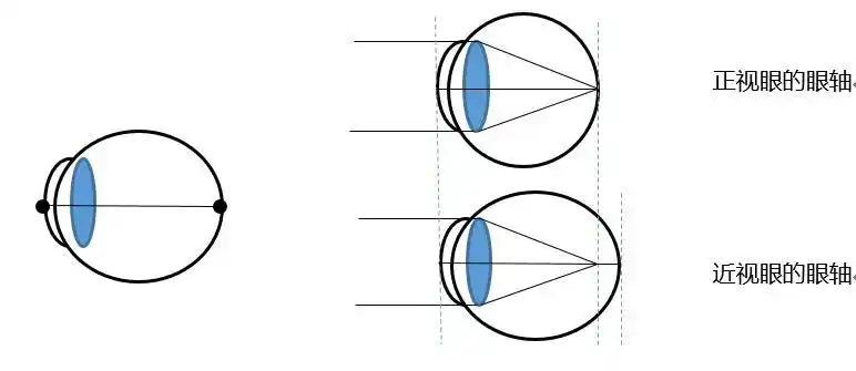 谨慎选择哺光仪治疗近视