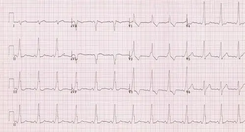 健康体检所见一例心电图