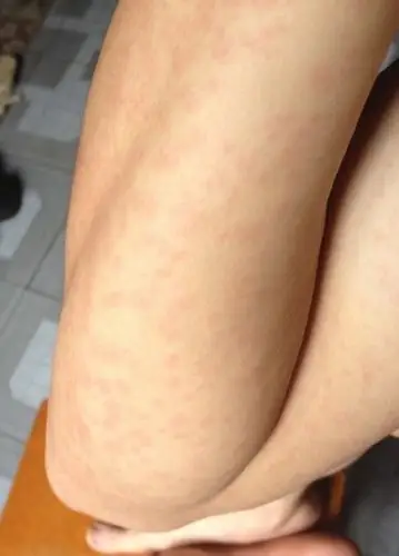 梅毒图片_梅毒症状表现图片大全_有来医生