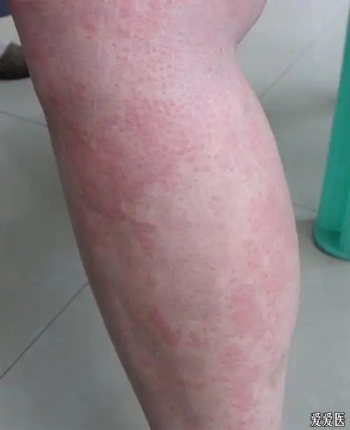 荨麻疹及中西医治疗