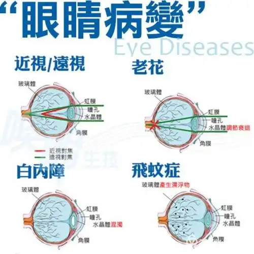 眼睛的9种疾病及适用的usana营养品