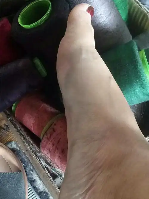 脚莫名其妙的乌青,冷水洗下就退去了.这怎么回事