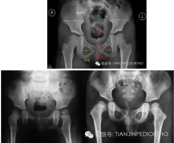 儿童股骨头坏死---标准骨盆正位,双髋蛙位片的问与答 - 好大夫在线