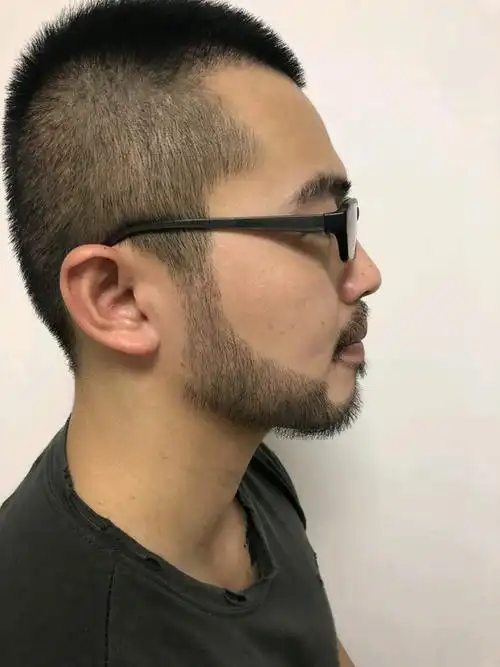 男士胡须鬓角种植案例#有人看得出来这是种植的胡须_圈子-新氧美容