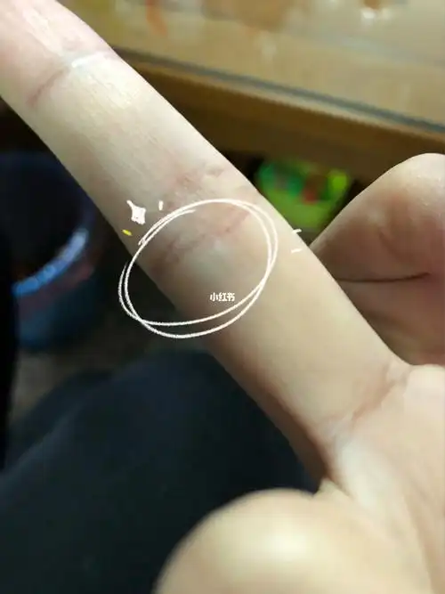 突然皮下长了一个淤青色的东西,摸起来是个可移动的小疙瘩,疼.