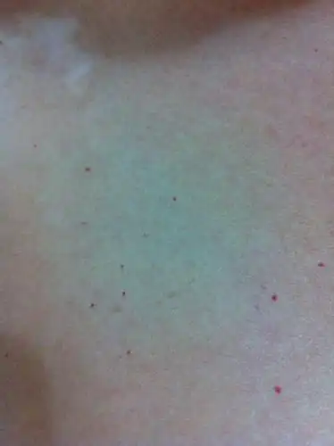 胸口周围一些小红血点,不疼不痒,时间很长了,怎麽回事?有图