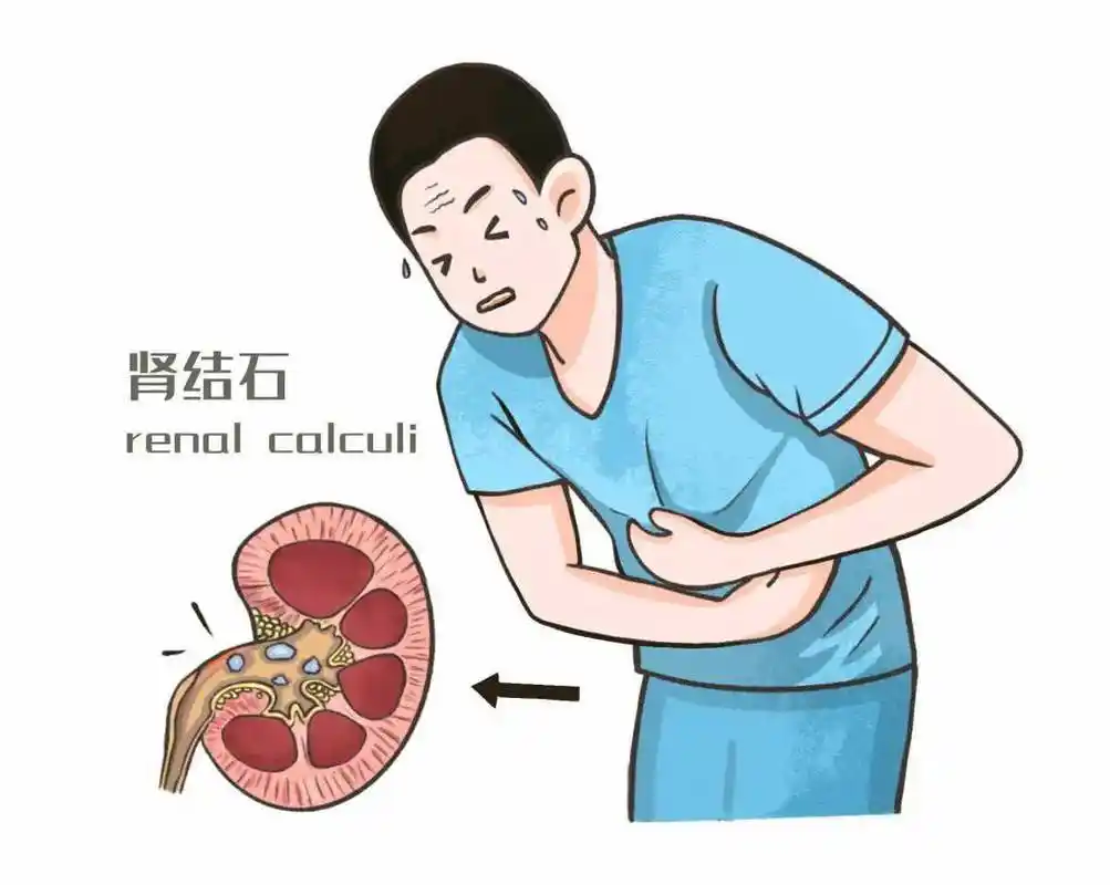 大二小伙天天打球还长结石!医生提醒:这几类食物不能一起吃