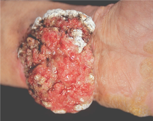 什么是鳞状细胞癌?是如何引起的?如何预防与治疗?