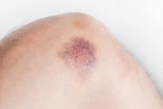 7,肝硬化若经常酗酒,患有肝炎疾病且皮肤瘀青,需警惕肝硬化.