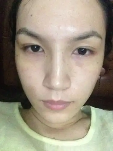 一个月前因使用脱毛膏不小心灼伤脸部皮肤,结痂之后红印迟迟不退,很是