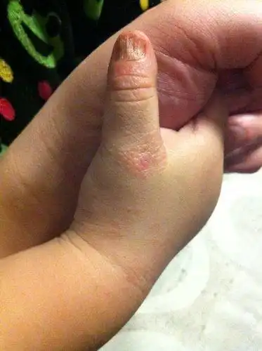 孩子现在两岁了,从七八个月开始大拇指指甲就开始开裂,满指甲盖都是竖