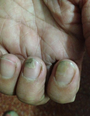 轻微灰指甲图片 (17)_有来医生