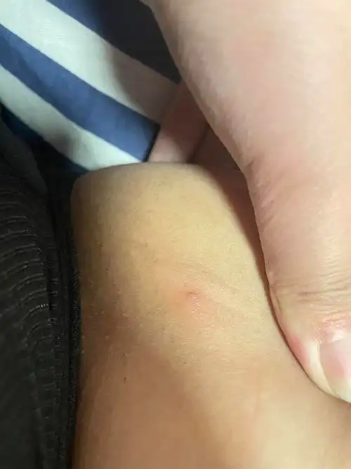 大腿内侧长了这个东西,姐妹们看看是尖锐湿疣吗