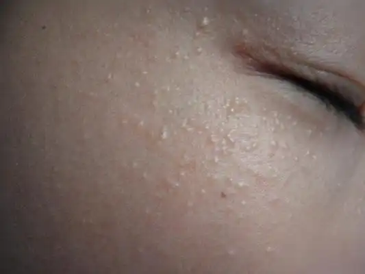 粟丘疹