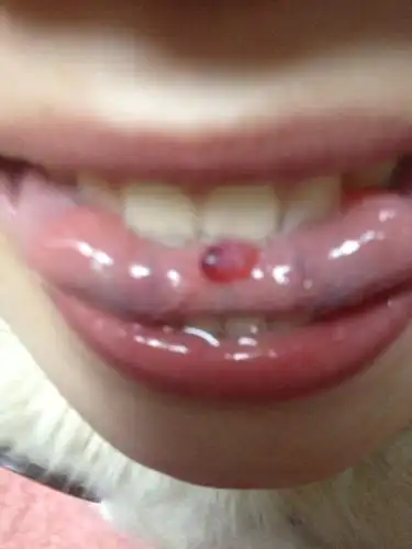 舌头下面起一个小水泡,请问是怎么回事?