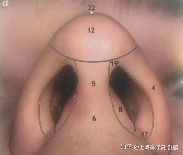 是什么原因导致鼻小柱下垂或者退缩呢