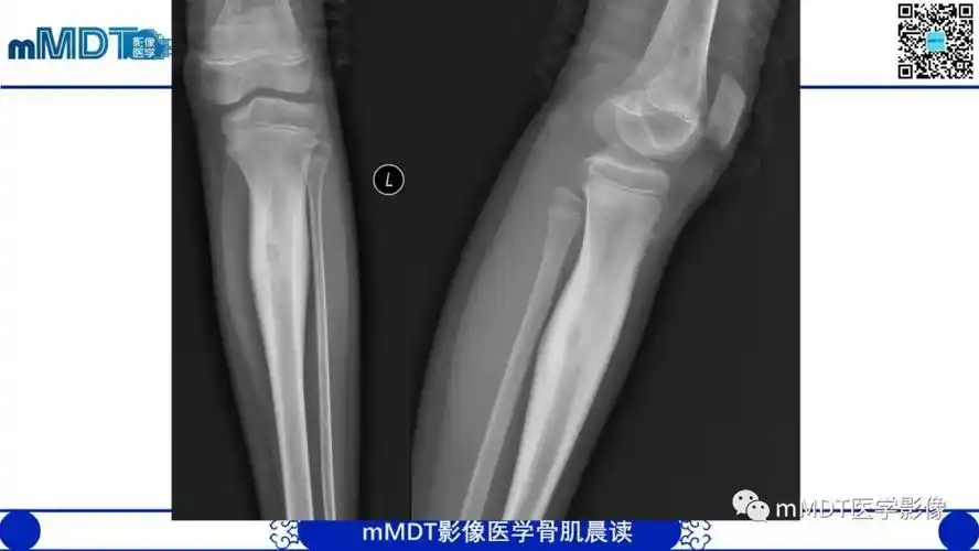 骨样骨瘤典型病例语音赏析