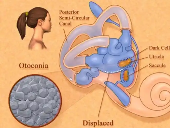 我晕折腾人死去活来的眩晕竟是耳石惹的祸咋办