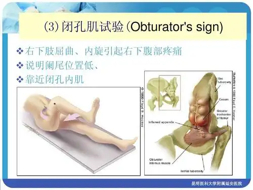 第八版课件ppt 医学生大三,大四,临床医学 (3)闭孔肌试验(obturators