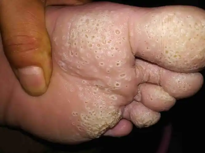 我这脚属于什么性质的皮肤病?用什么药或者怎样治疗能医治康复?