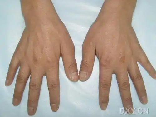 手内肌,小鱼际萎缩,掌骨间肌明显凹陷.各手指内收外展重限.