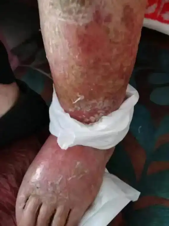 左下肢(小腿)和左脚丹毒治疗两天则愈. - 抖音