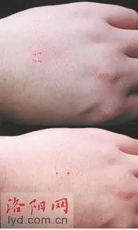 被蛇咬了的紧急处理和如何分辨毒蛇和无毒蛇