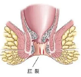 北京东大肛肠医院评价 肛裂 肛裂的症状          饮食调节也是预防