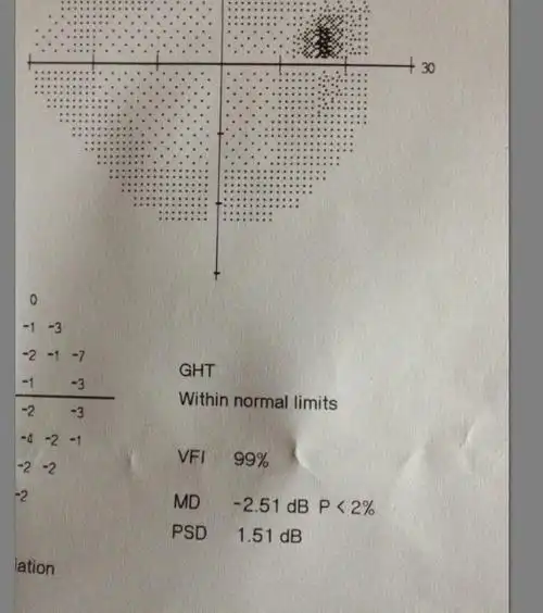 请问医生我的视野正常吗?是不是只有vfi100%才是正常的?