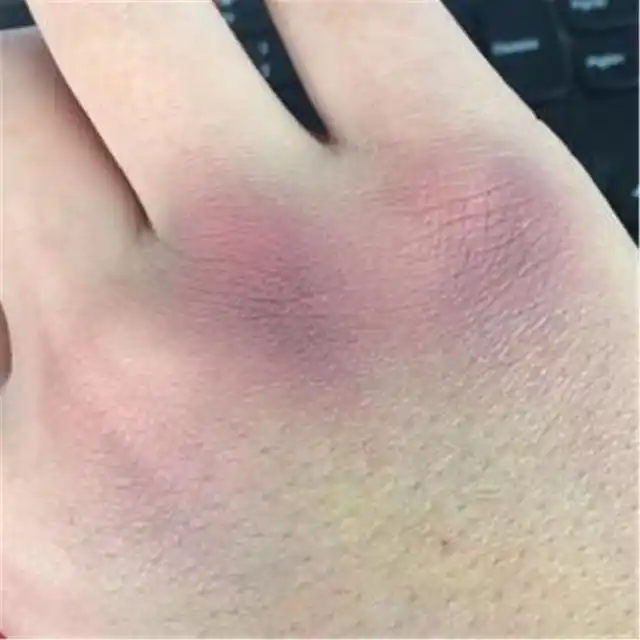 宝宝出生后屁股上为何有"淤青"?有必要治疗吗?一文讲清